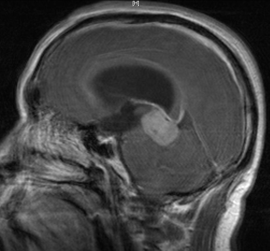 O que é neoplasia maligna do encéfalo?